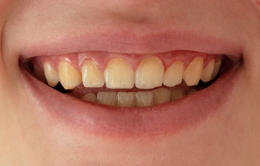 blanqueamiento dental en bogota
