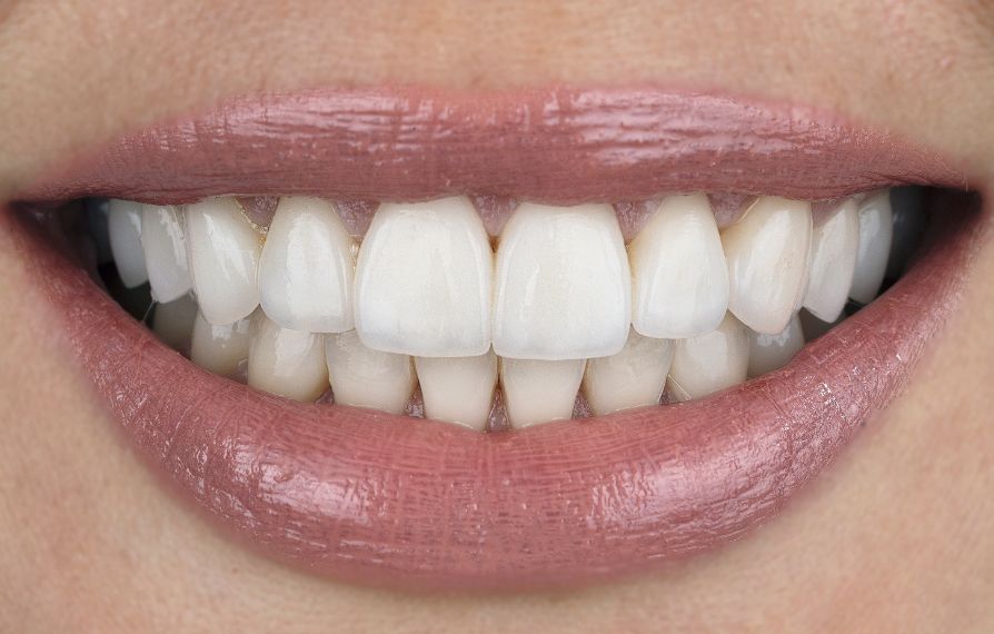 diseño de sonrisa en chia