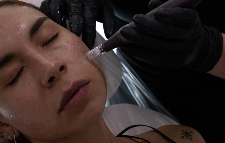 tratamiento dermapen bogota