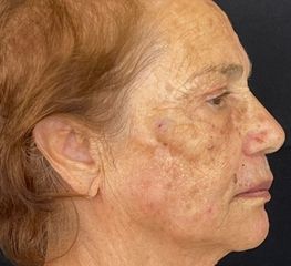 tratamientos con plasma en chia