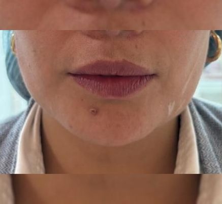 tratamientos de hilos pdo en bogota