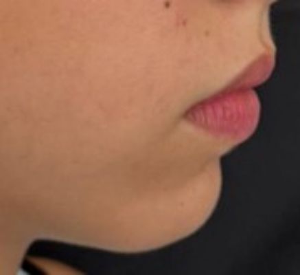 tratamientos de proyeccion de menton