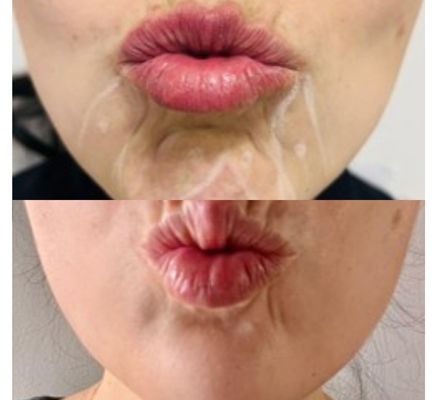tratamientos para las arrugas en chia