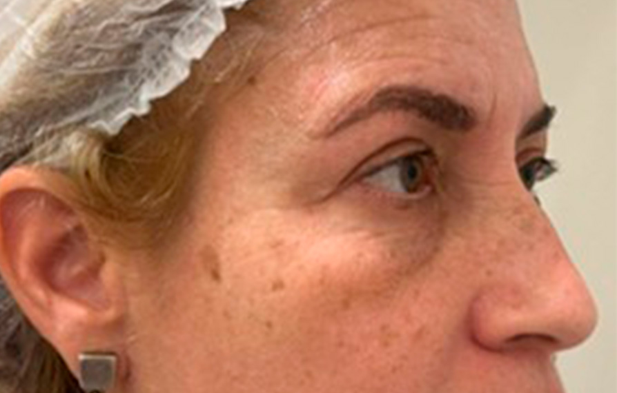 tratamientos para ojeras en bogota