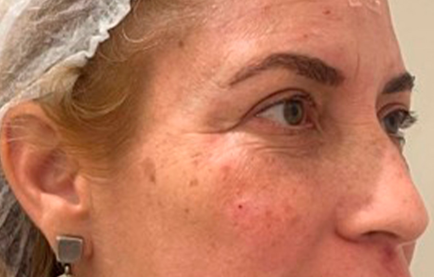 tratamientos para ojeras en chia